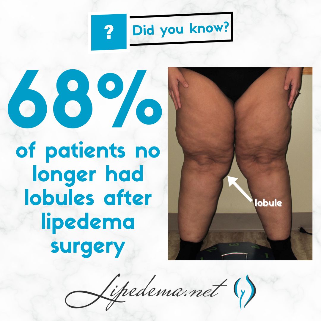 Lipedema Reduction Surgery for Improved Mobility and Quality of Life