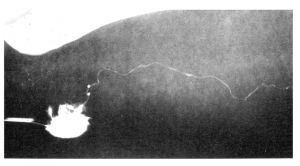 lipedema early stages lipedema early stages