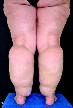 Lipedema Awareness