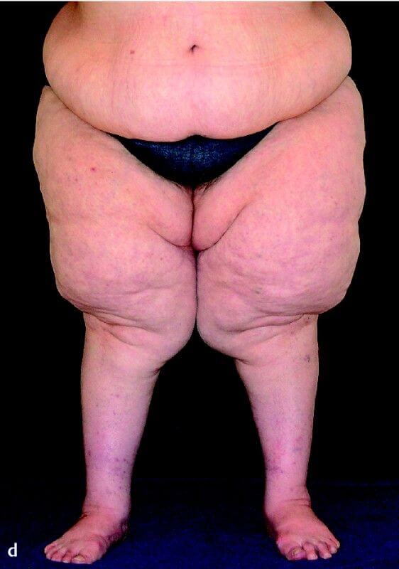 Lipedema Awareness