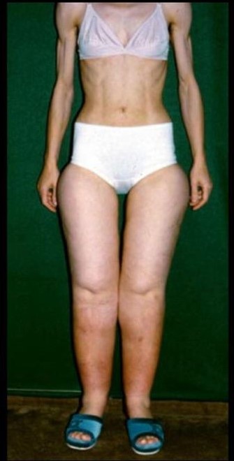 What is Lipedema Fat