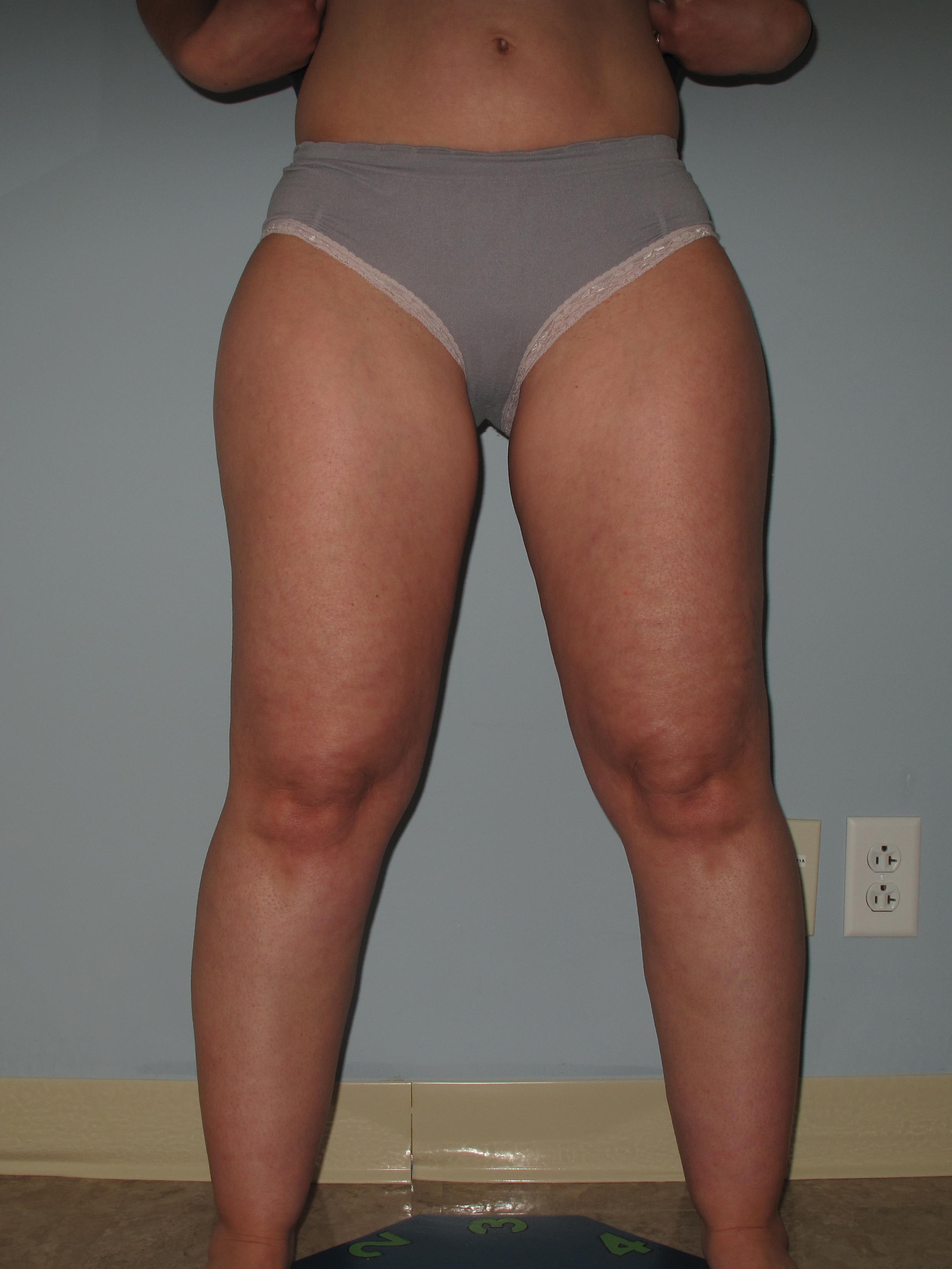 what is Lipedema fat