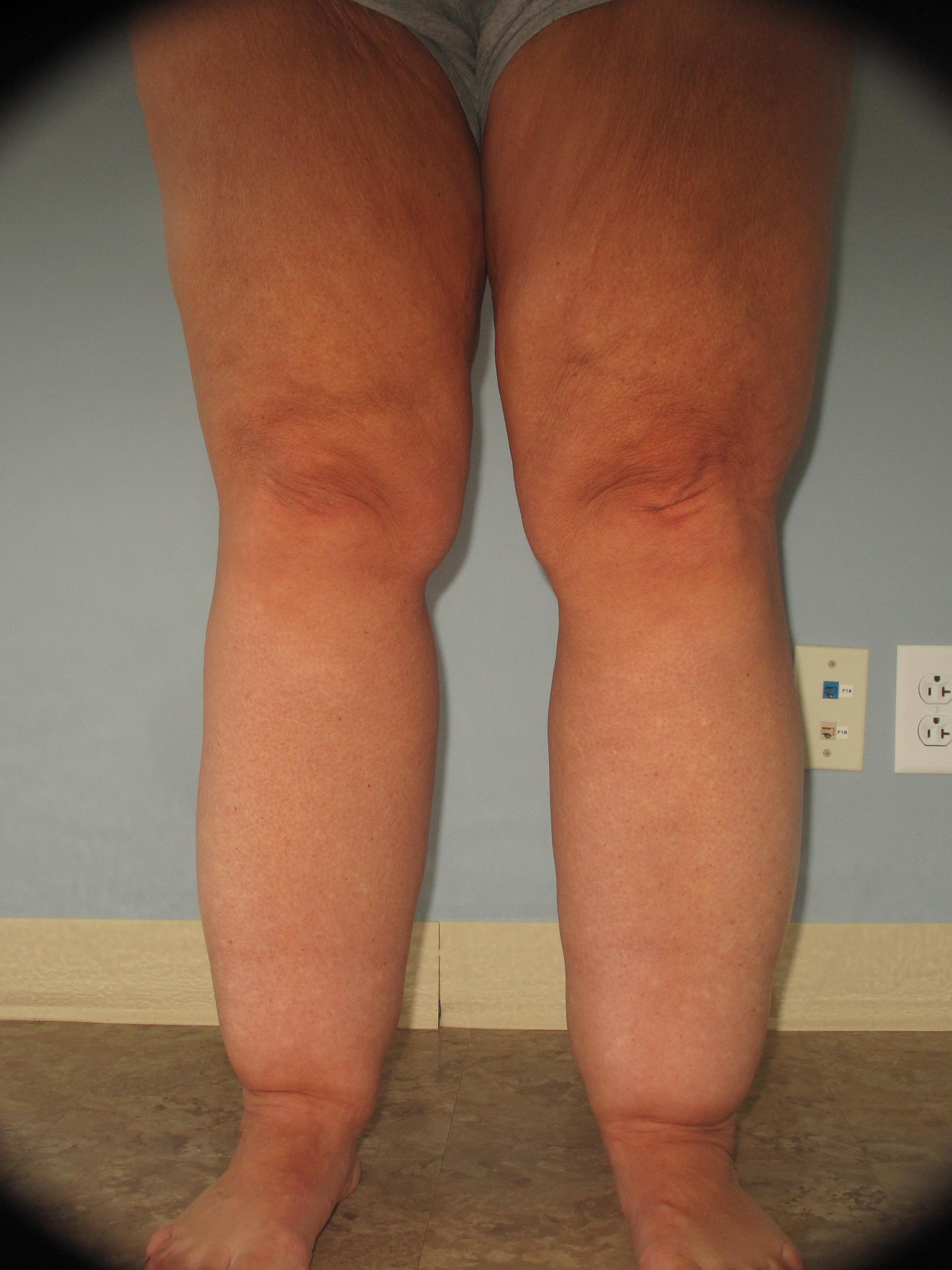 what is Lipedema fat