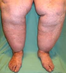 lipedema lipo