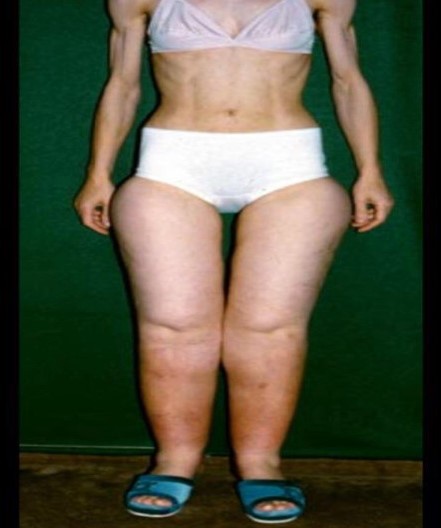 lipedema lipo