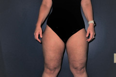 Classic-Lipedema-Woman-