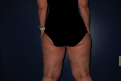 Classic-Lipedema-Woman3