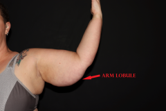 LIPEDEMA-ARM-LOBULE-LABLED