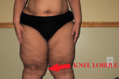 LIPEDEMA-KNEE-LOBULE-LABLED