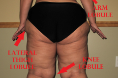 LIPEDEMA-LATERAL-THIGH-LOBULE-LABLED-1