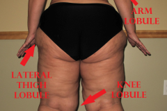 LIPEDEMA-LATERAL-THIGH-LOBULE-LABLED