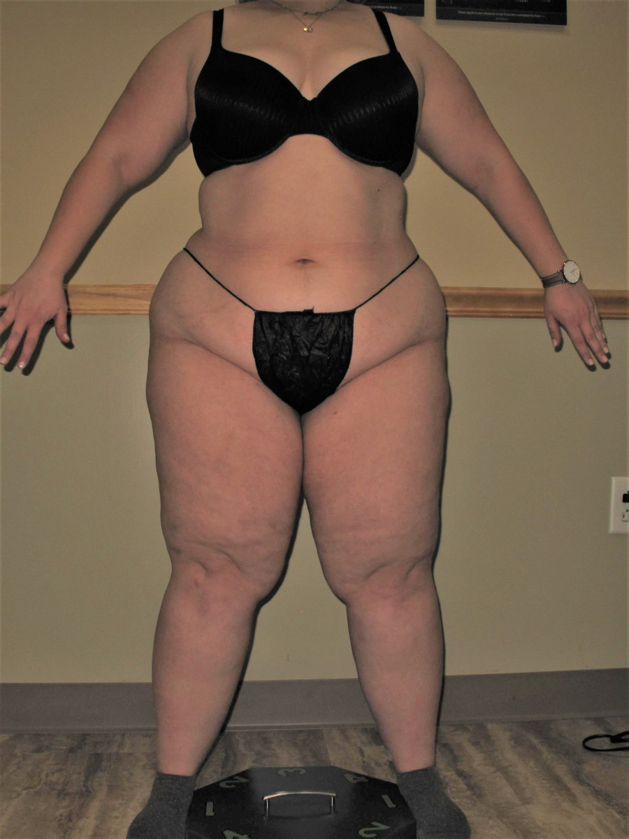 Where Does Fat Lipedema Tissue Accumulate in the Body | Lipedema.net