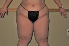 Lipedema-lower-body-3