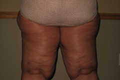 Lower-Body-Lipedema-1