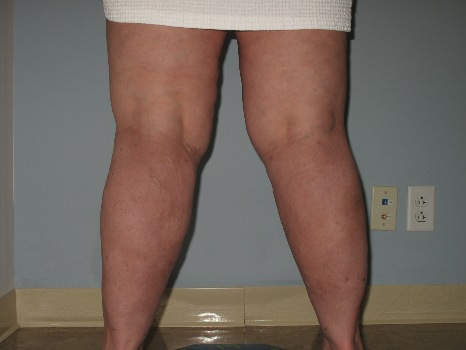 Learn if Fat Legs Are Considered Lipedema