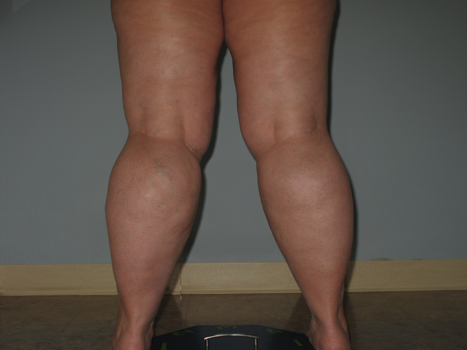 Learn if Fat Legs Are Considered Lipedema