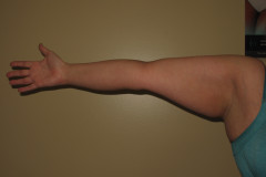 Lipedema-Arms-1