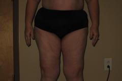 Upper-Body-Lipedema-3