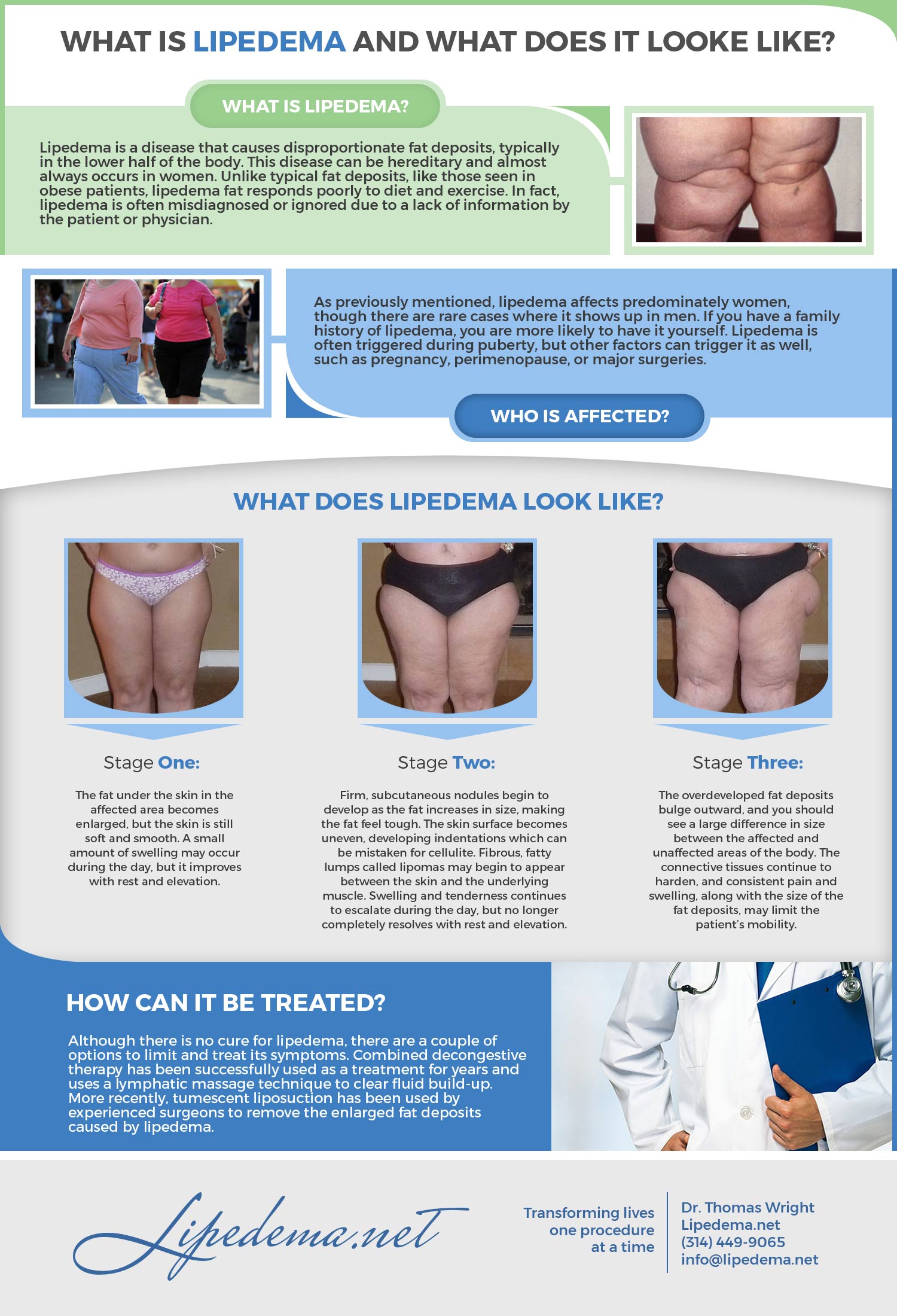 Lipedema (also known as Lipoedema or Lipodema) is a pernicious