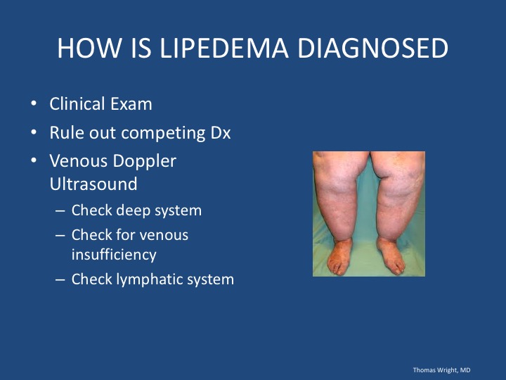 Lipedema (also known as Lipoedema or Lipodema) is a pernicious