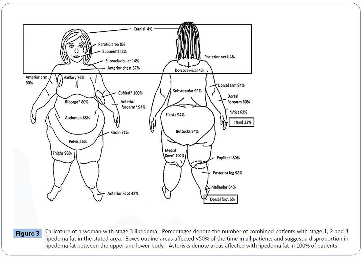 Lipedema ankles