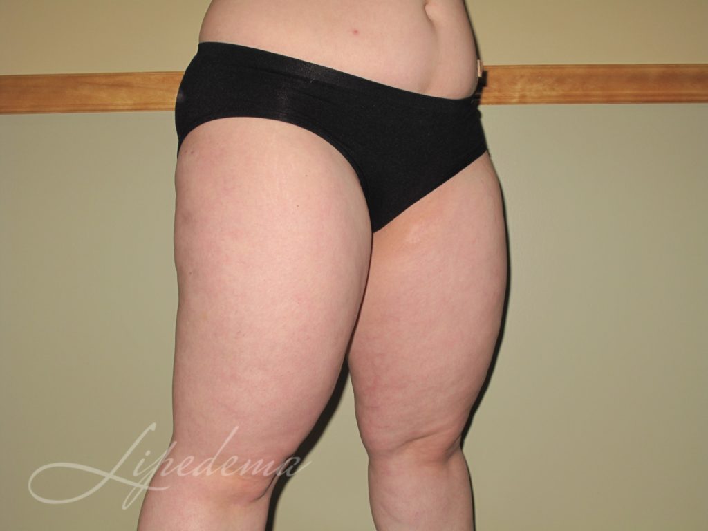 living with lipedema