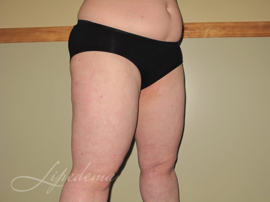 living with lipedema