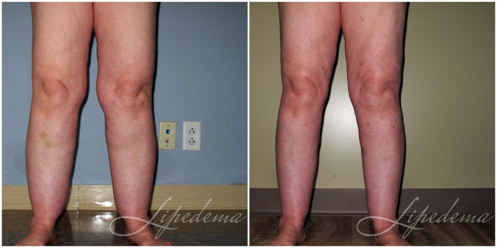 Lipedema Guidelines and Standards for Liposuction