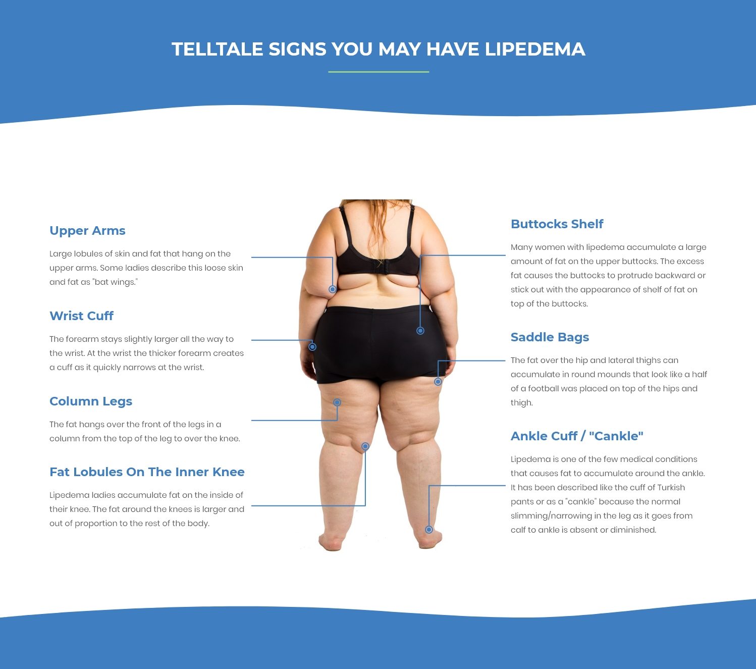 Battle for Your Lipedema Insurance Coverage | Lipedema