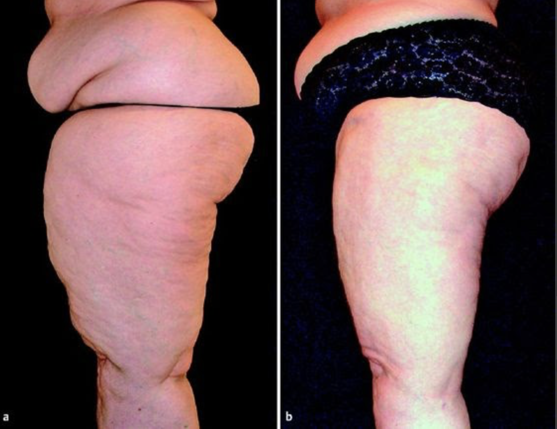 liposuction