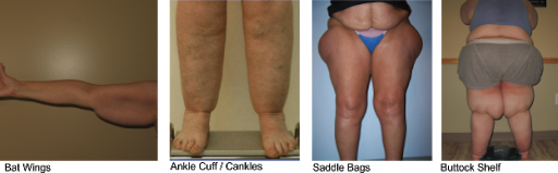 Lipedema calves