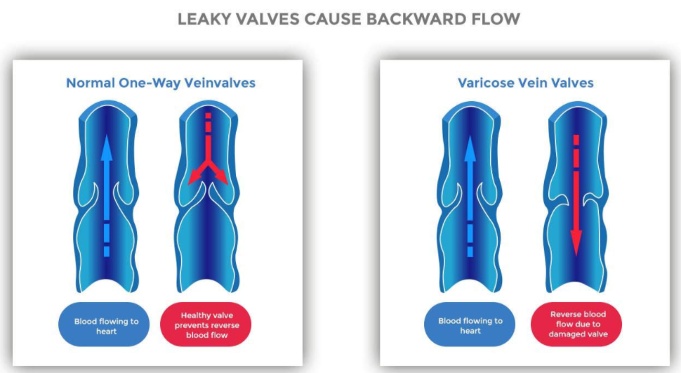 Lipedema calves