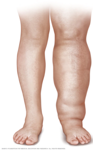 Lipedema calves