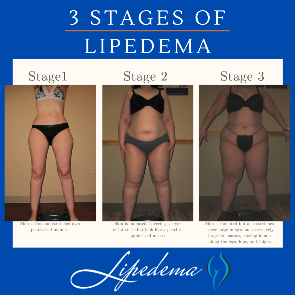 3 Stages of Lipedema Infographic
