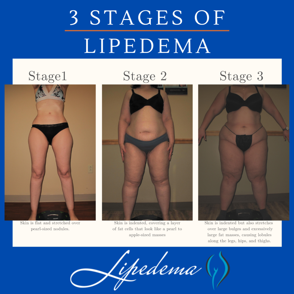 Follow These 4 Steps to a Lipedema Diagnosis