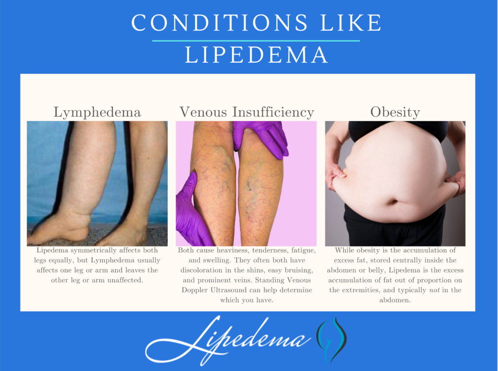 Follow These 4 Steps to a Lipedema Diagnosis