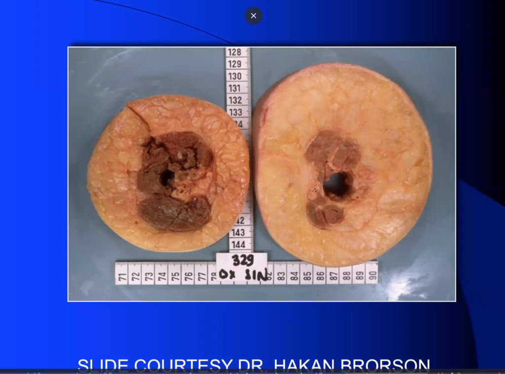 treat lipedema Cause of Lipedema