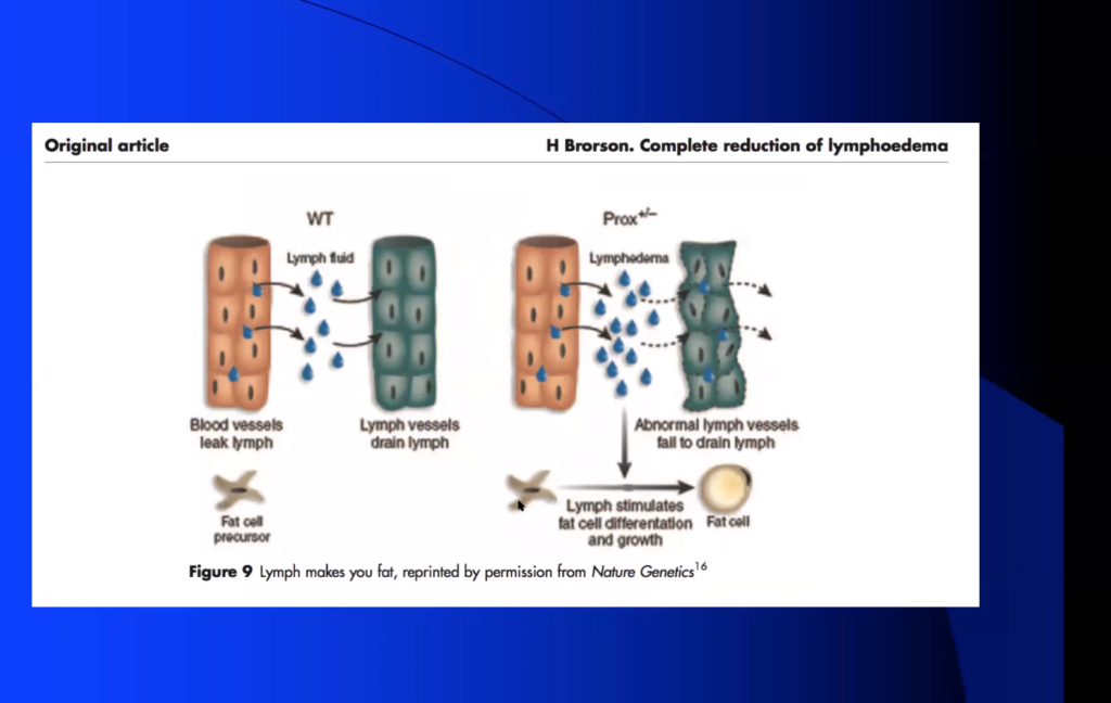 treat lipedema Lymph Makes you Fat: Brorson Nature Genetics