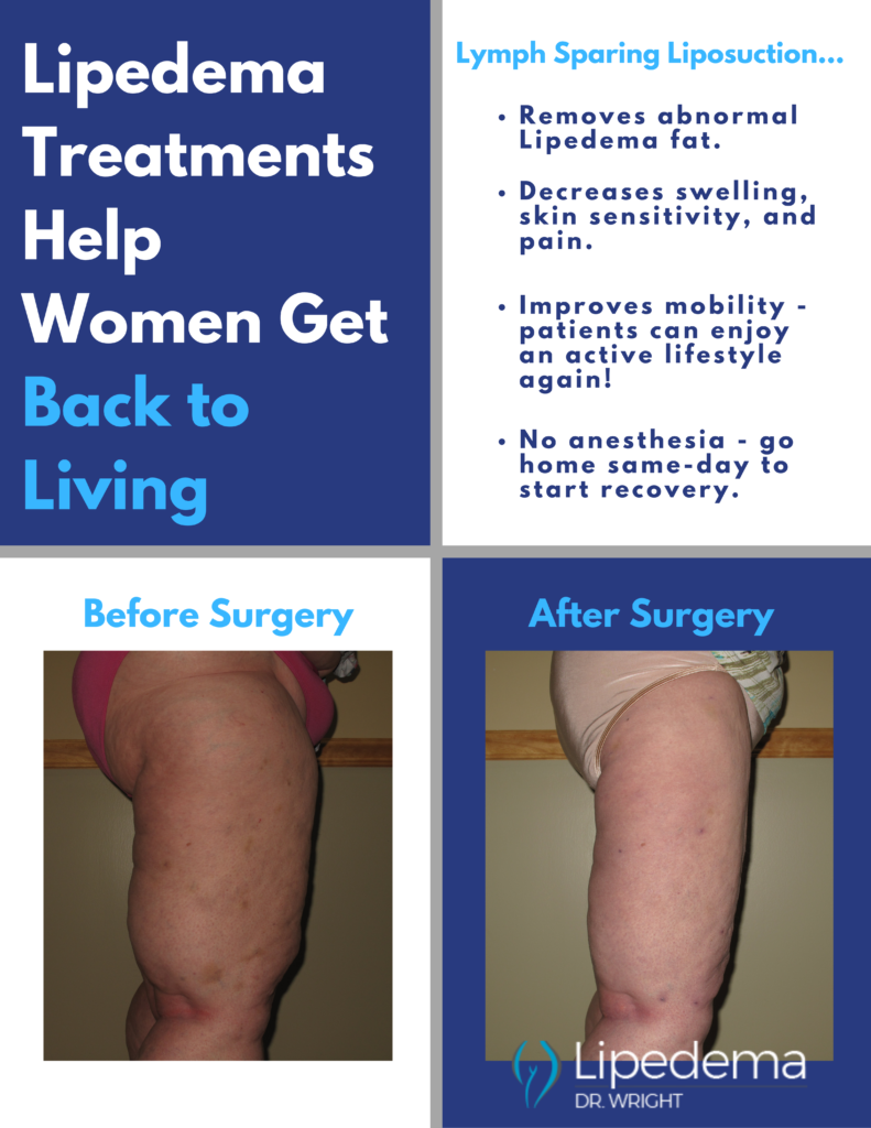 Treating Lipedema Changes Women Lives