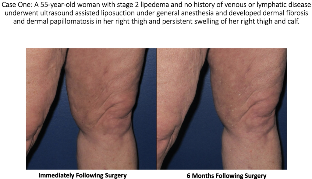 Case 1 Lymphatic Injury Lipedema Liposuction