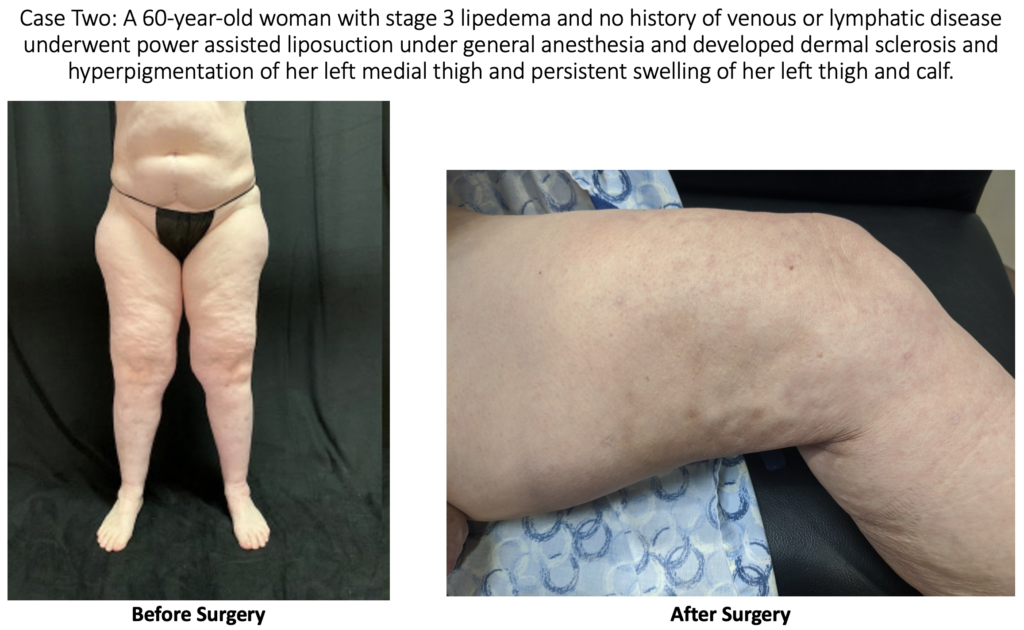 injury after liposuction