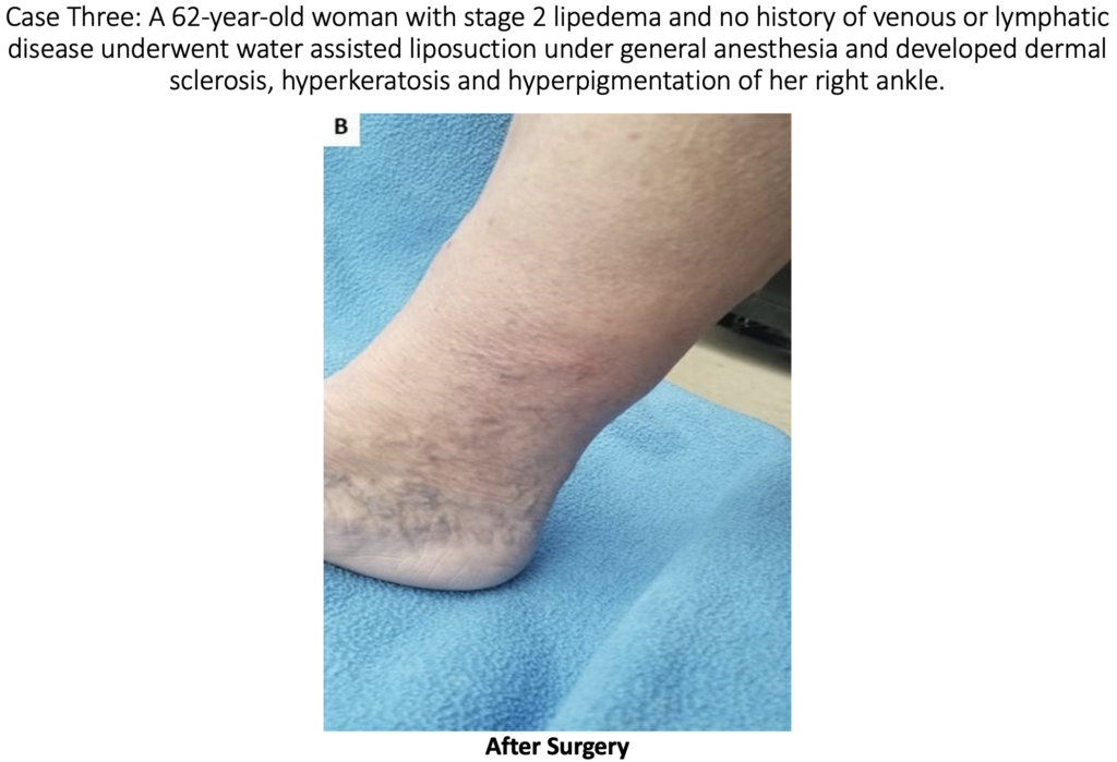 injury after liposuction