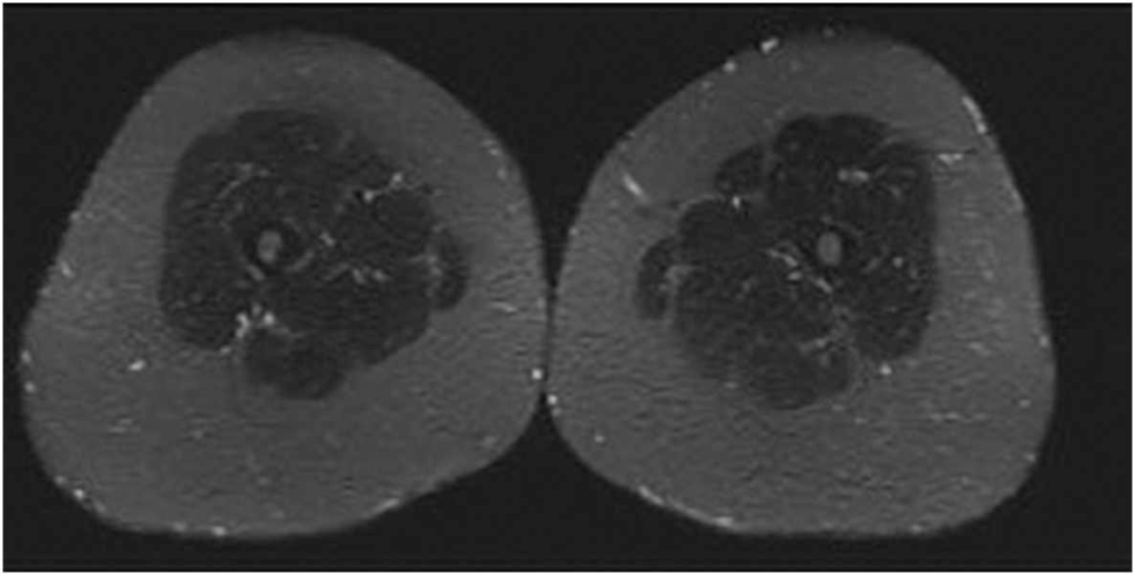 Lipedema MRI