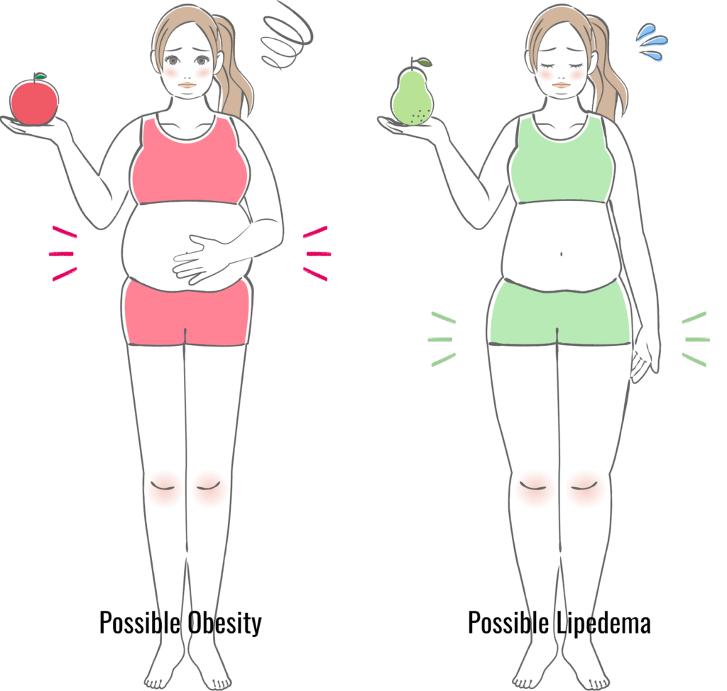Obesity vs Lipedema