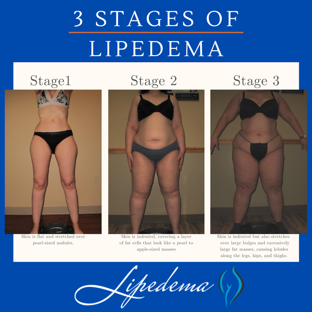 3 Stages of Lipedeman Infographic