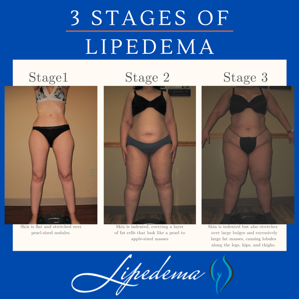 Exercises for people with lipedema: tips and recommendations - Lipepedia