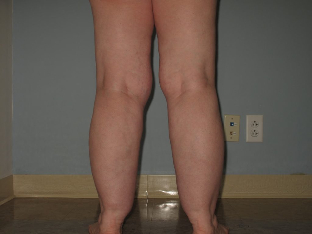 Photo of lipedema on calves