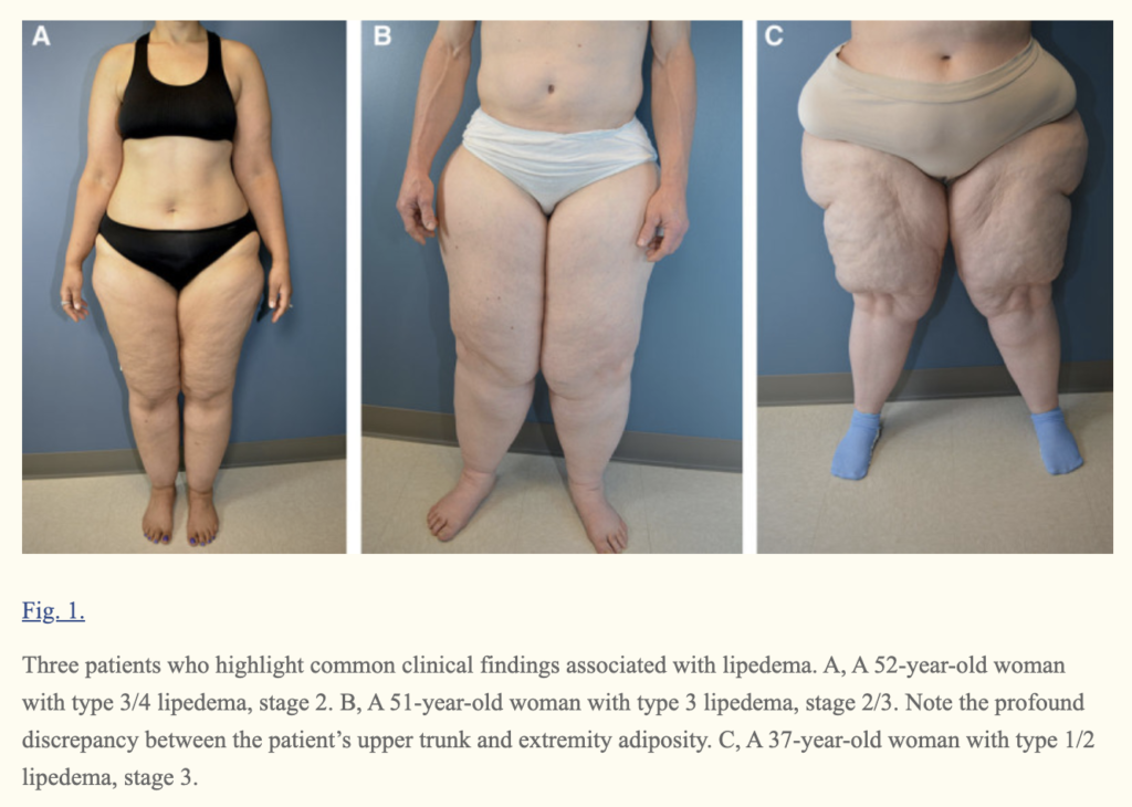 Lipedema Stages
