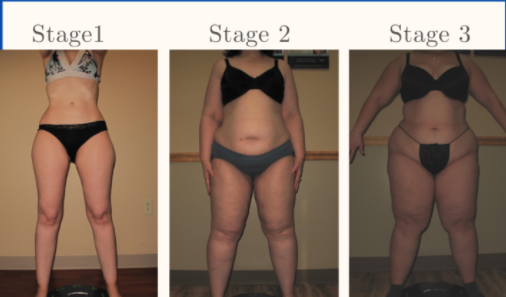 Lipedema Infographic displaying the stages of lipedema