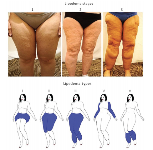 Lipedema  Fat Disorder - Causes, Stages, Symptoms, Diagnosis